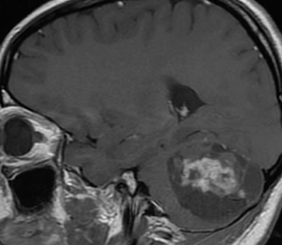 pilocytic astrocyoma